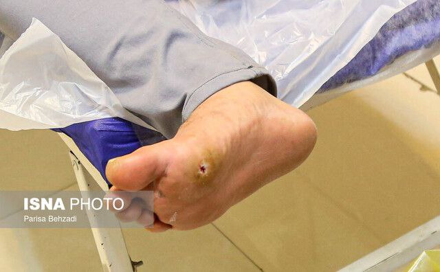 زخمهای دیابت، کشندهتر از سرطانعلامه، پزشک در گفتوگو با زخمهای دیابت، کشندهتر از سرطانعلامه، پزشک در گفتوگو با