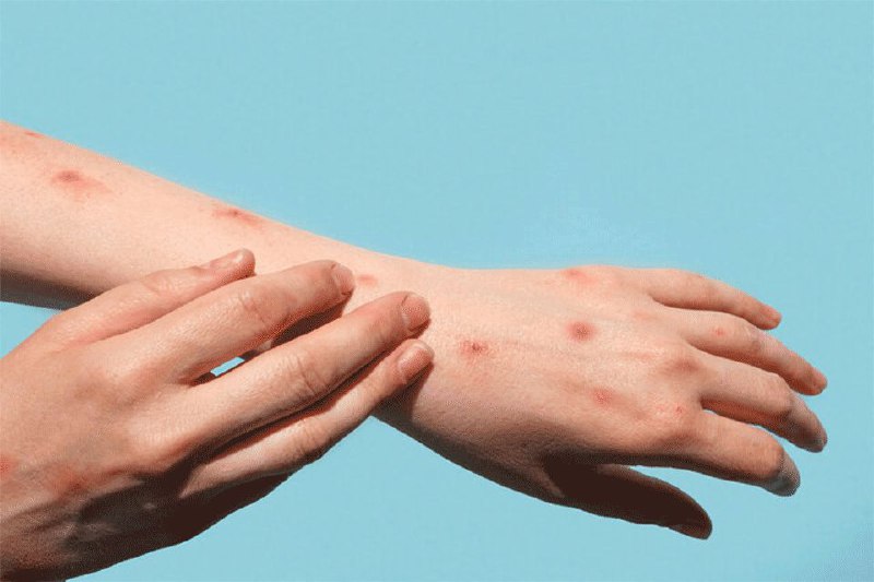 وزارت بهداشت: هیچ موردی از آبله میمونی در کشور تایید نشده‌است