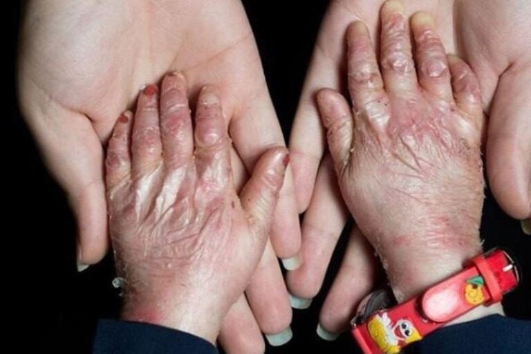 تلاش‌ برای تولید داخلی «پانسمان بیماران پروانه‌ای»